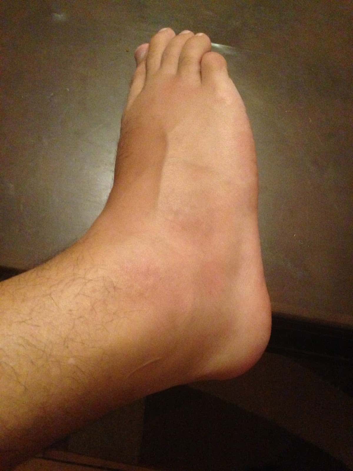 My foot at its worst in Moda, Kadıköy, İstanbul, Turkey
